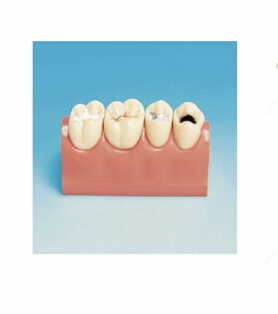 STUDY MODEL CARIES DETECTION